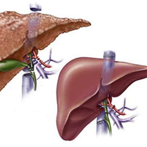 Liver Transplant And Gastrointestinal Gi Surgeon In India