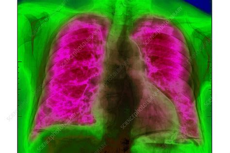 Lung Metastases X Ray Stock Image C Science Photo Library