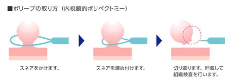 日帰り大腸ポリープ切除術｜宇土内科胃腸科医院｜熊本市中央区