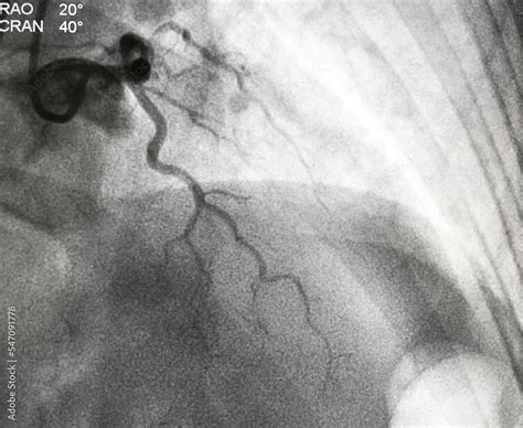 coronary angiogram shown massive thrombus that occluded left anterior descending artery (LAD) in ...