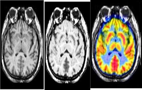 Figure1 Fusion Of SPECT And T2W MRI Images A SPECT Image