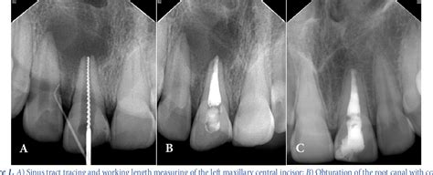 Figure 1 From Nonsurgical Endodontic Management Of Large Periapical