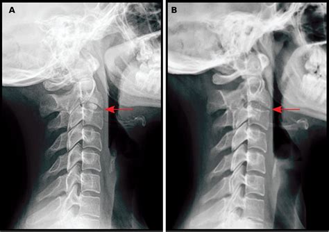 Adult Onset Acute Calcific Discitis The Journal Of Rheumatology