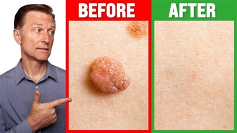 How To Remove Skin Tag In 1 Night Acu Doctor