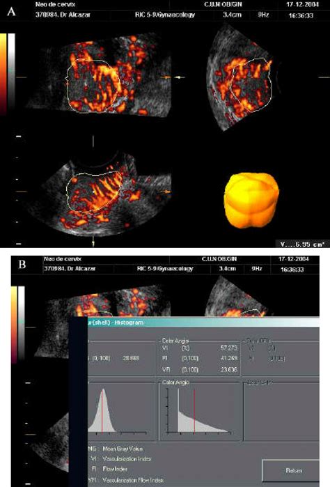 Three Dimensional Power Doppler Ultrasound From A Case Of Cancer Of The