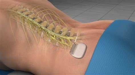 Spinal Cord Stimulator Trial (for pain after surgery) - Cahaba Pain and ...