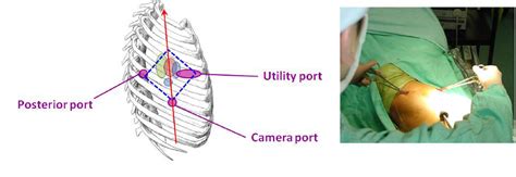 Figure From The Evolution Of Minimally Invasive Thoracic Surgery