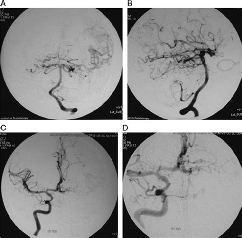 Second Angiogram After Left ICA Ligation A And B Left Vertebral