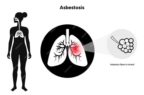 Premium Vector Asbestosis Lungs Diseases Lungs Problem Lungs Icon