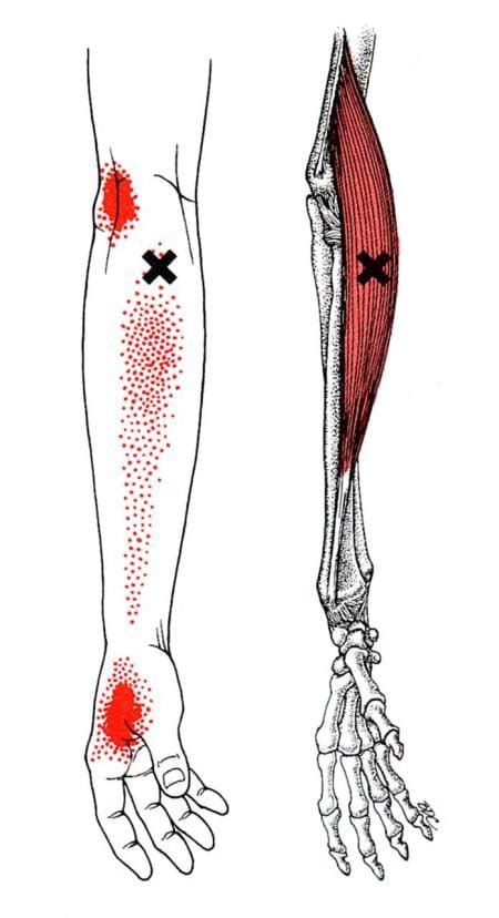 Manage Trigger Points In The Hands And Wrist El Paso TX Sciatica