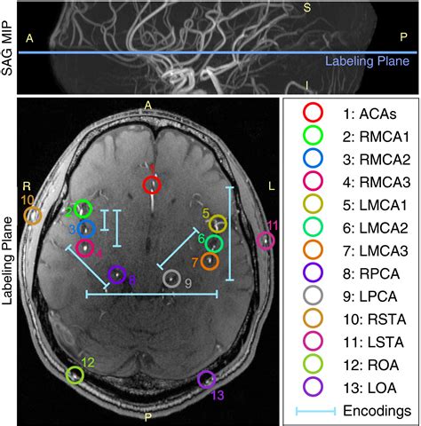 Visualizing Arteryspecific Blood Flow Patterns Above The Circle Of