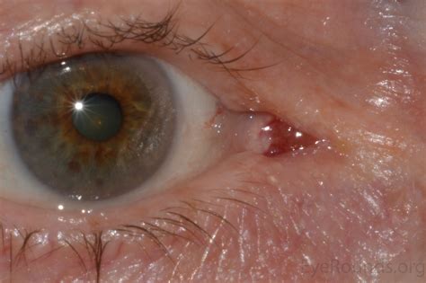 Atlas Entry Conjunctival Oncocytoma