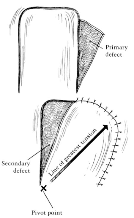 Transposition Flap