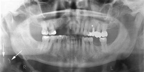 Ultrasonographic Confirmation Of Carotid Artery Atheromas Diagnosed Via