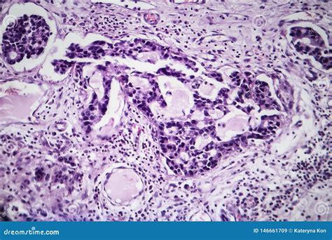 Ad Nocarcinome Gastrique Micrographe L Ger Illustration Stock