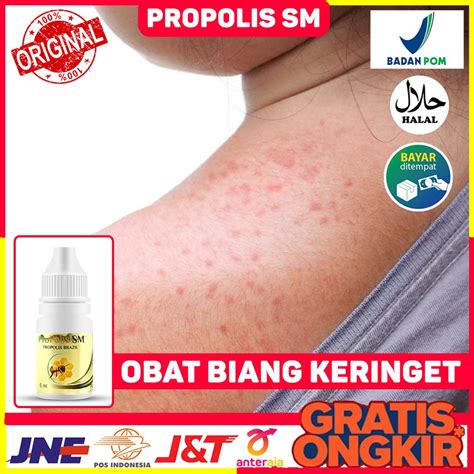 Jual Obat Biang Keringat Obat Miliaria Rubra Obat Bintik Bintik