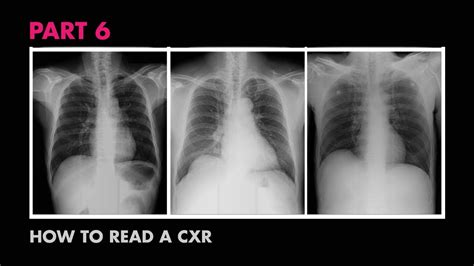 Cxr Bones Soft Tissue How To Read A Chest X Ray Part Medzcool