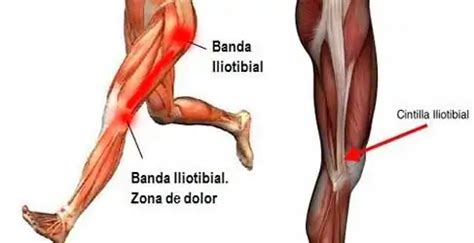 Síndrome de la Banda Iliotibial SBIT Cómo tratarla