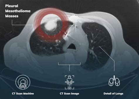 Pleural Mesothelioma Treatment Prognosis Survival