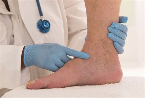 Pitting Edema Grading When Swelling Becomes Serious