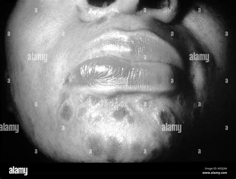 A Photograph Of A Patient With Secondary Syphilis Showing Typical