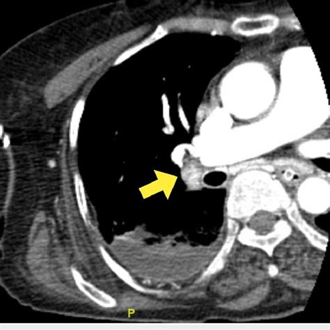 Computed Tomography Of The Chest Showing A Pulmonary Embolism In The Download Scientific