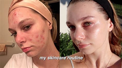 How Skin Cycling Transformed My Acne Prone Skin Youtube