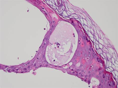 Incontinentia Pigmenti (Bloch-Siemens syndrome, Bloch-Sulzberger syndrome, Bloch-Sulzberger ...