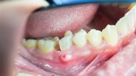 Abscesso Dentário Grave Com Celulite Disseminada - Abscesso Dental: O que é, Causas e Tratamento