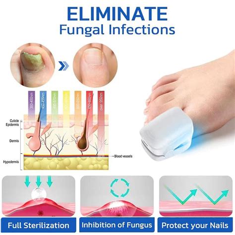 Nail Laser Treatment Device Fsa Or Hsa Eligible Nail Fungus Laser