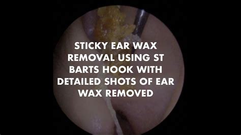 Sticky Ear Wax Removal Using St Barts Hook With Detailed Shots Of Wax