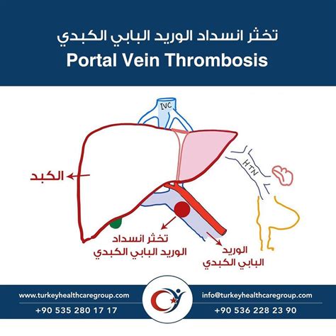 Hepatic portal vein thrombosis - Turkey Health Care Group