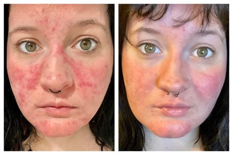 Can Somebody Help Me Identify My Redness Rosacea