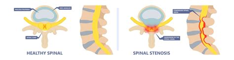 Neuropathy What You Need To Know Premier Neurology And Wellness Center