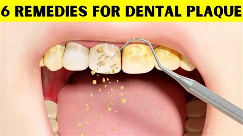 natural remedies  dental plaque    rid  dental plaque