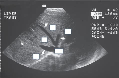 Liver Sonography Anatomy Diagram Quizlet