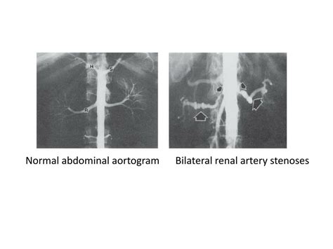 Ppt Aortorenal And Selective Renal Arteriography Powerpoint Presentation Id 3824159