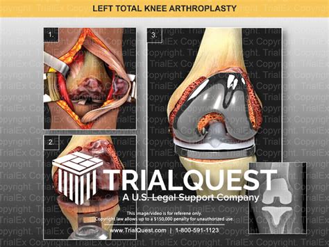 Left Total Knee Arthroplast Trial Exhibits Inc