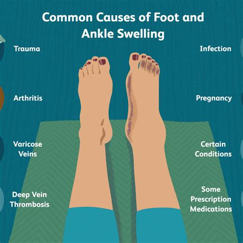 Exercises For Swollen Feet Home Guide Guru