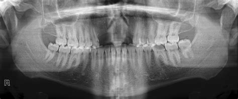 caries-detection Instance Segmentation Dataset by Laya room