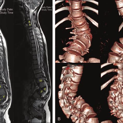 1 2 A Thoracolumbar 3 Dimensional Computed Tomography Reconstruction