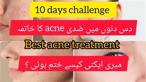 Acne Treatment Acne Khatam Karne Ka Tarika Best Acne Treatment