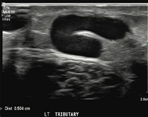 Varithena Treatment Of The GSV