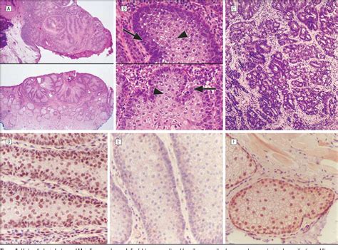 Figure 2 from Sebaceous adenoma of the eyelid in Muir-Torre syndrome ...