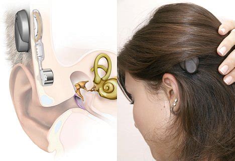 The Medel Bonebridge Bone Conduction Implant System ENT London