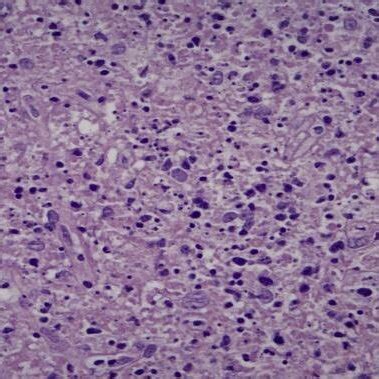 H&E 40x, cervical lymph node biopsy section showing abundant ...