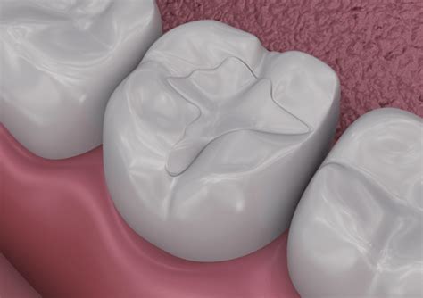 Sealants for Teeth | Qualified Dentists in Stamford, CT