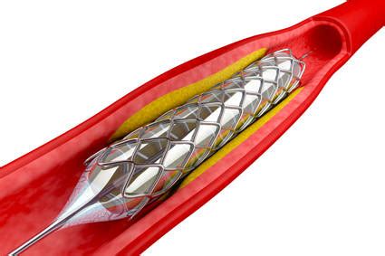 Complications and Risks After Stent Surgery | IYTmed.com