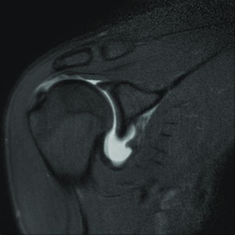 Coronal Fat Suppressed T2 Weighted Image With Contrast Demonstrating A