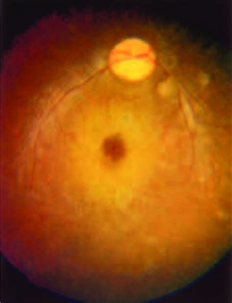 pigmentary retinal degeneration  scientific diagram